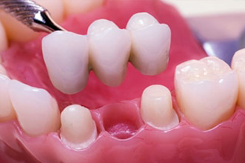 Dental bridge being placed -CDCP dentist Toronto offers tooth replacement solutions under the Canadian Dental Care Plan